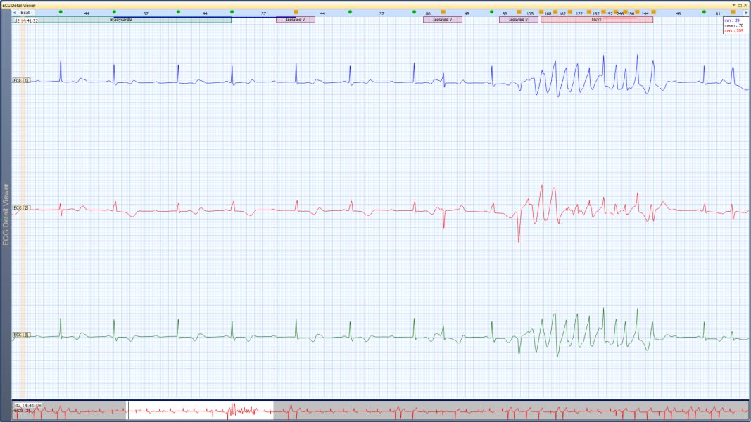 Ecg-holter1