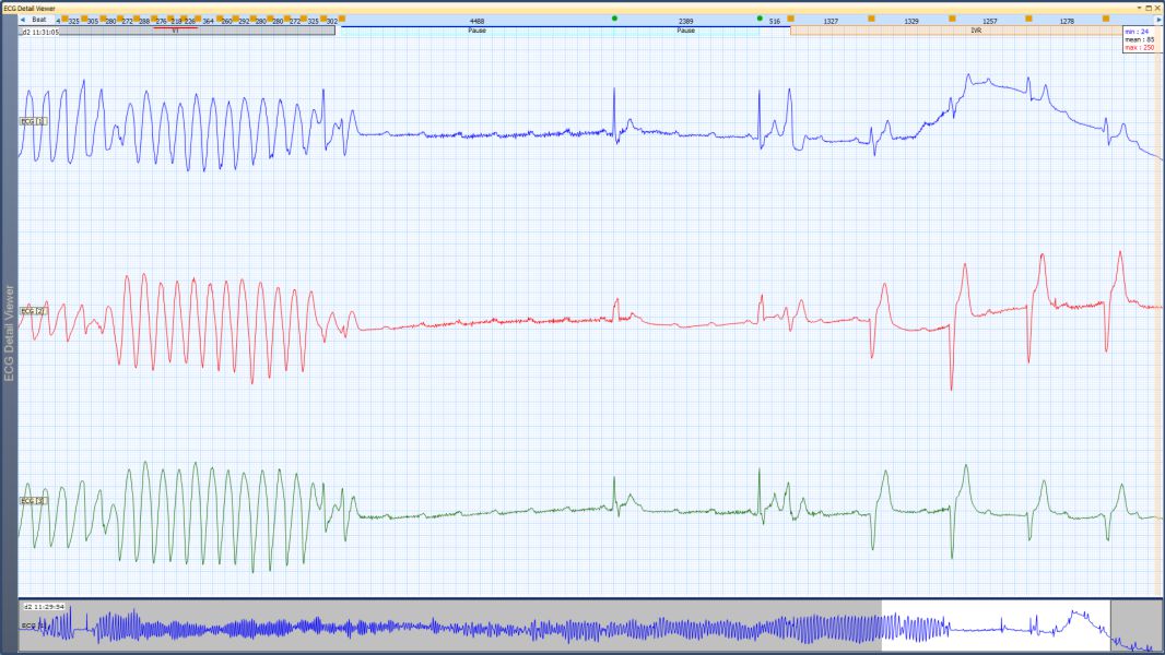 Ecg-holter2