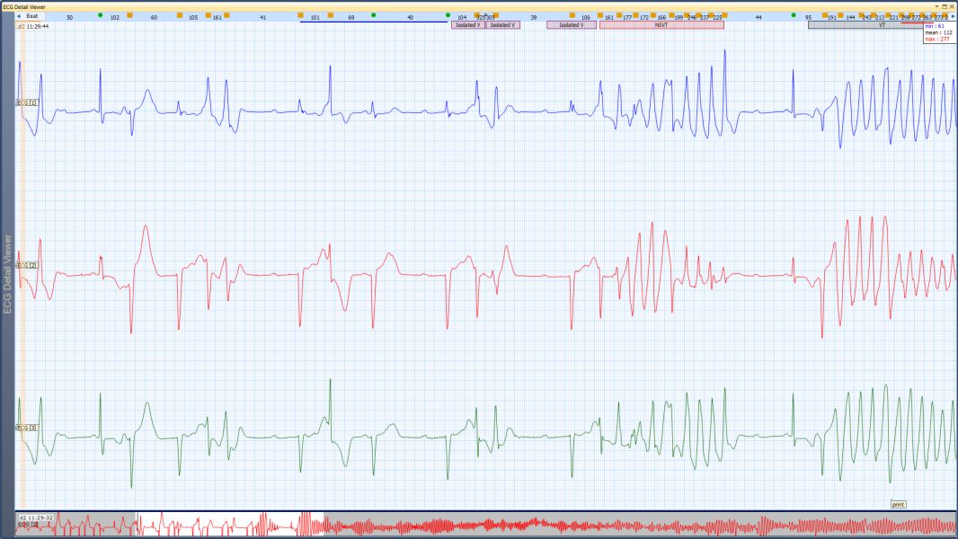 Ecg-holter3