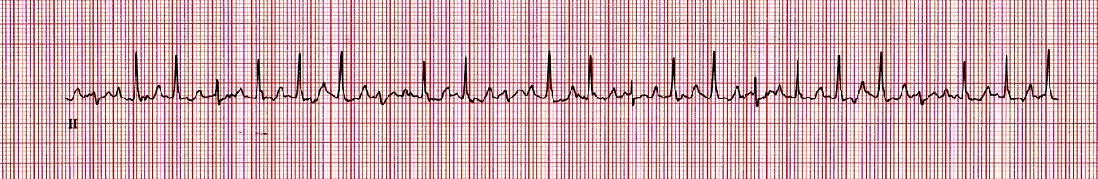 EcgFig1Dec